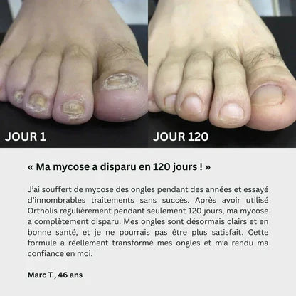 Adieu les Mycoses : Gel Réparateur pour Ongles Sains